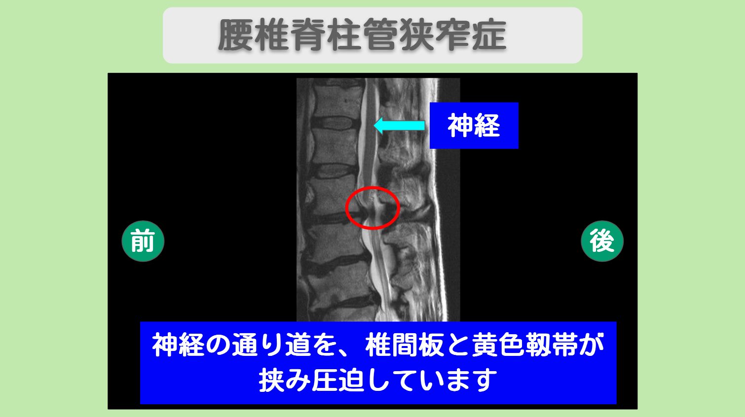 腰部脊柱管狭窄症