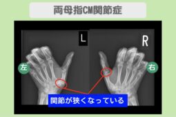 両母指CM関節症