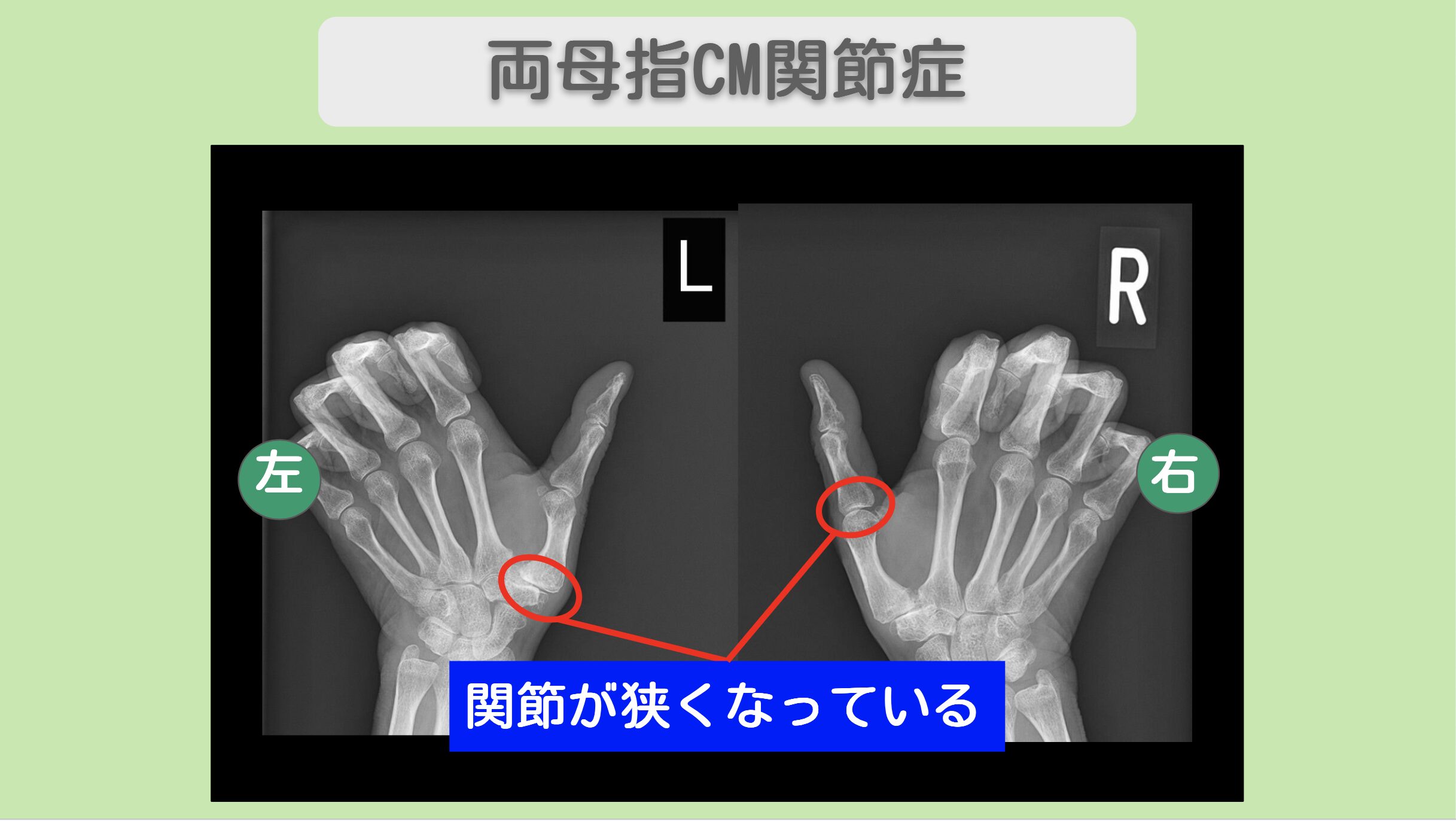 両母指CM関節症