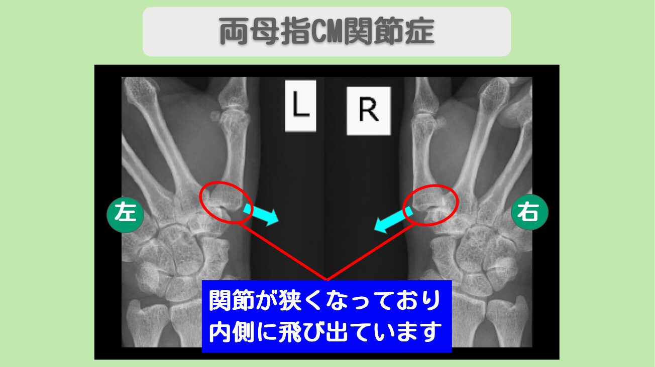 両母指CM関節症