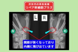 両母指CM関節症