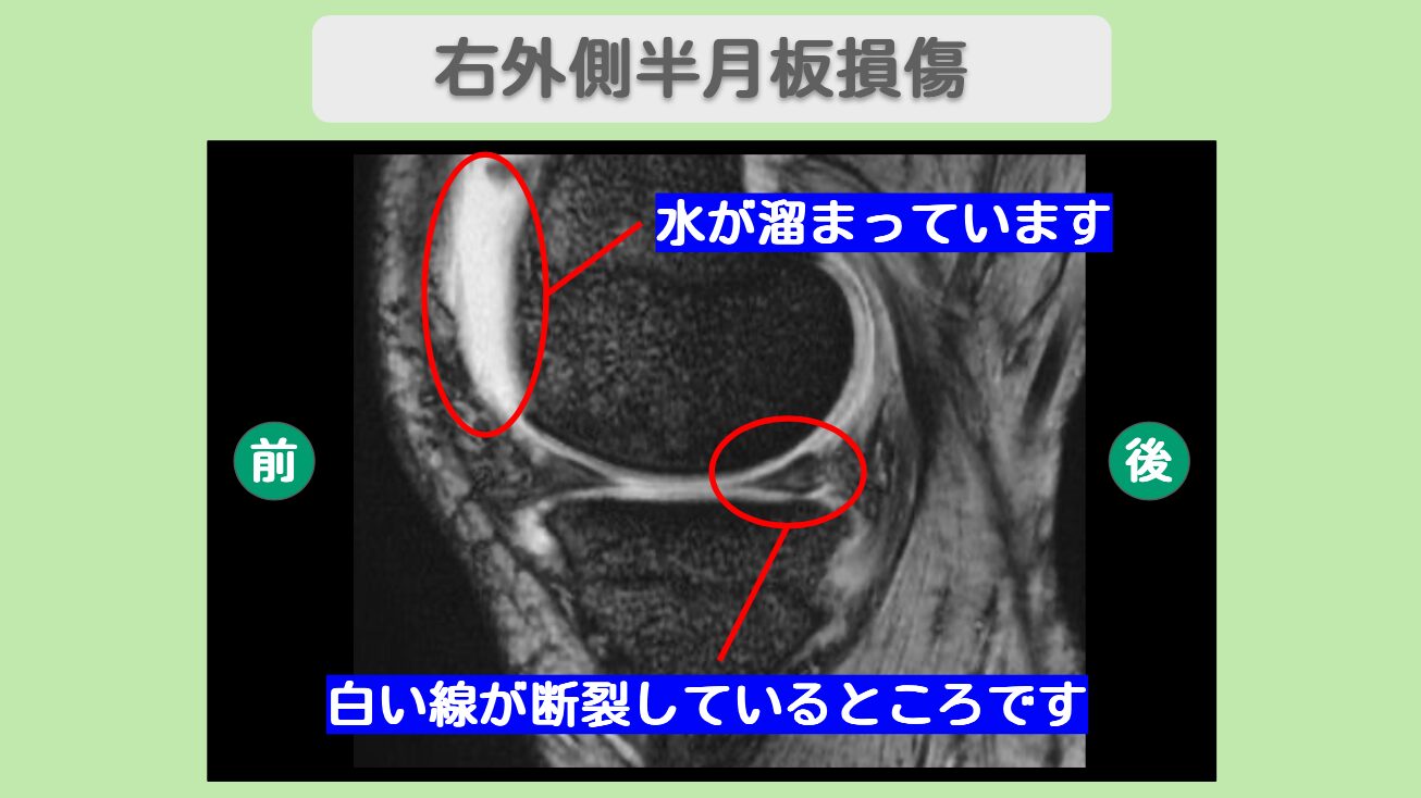 右外側半月板損傷・右変形性膝関節症