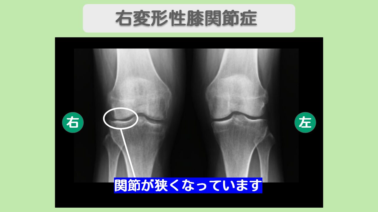 右外側半月板損傷・右変形性膝関節症