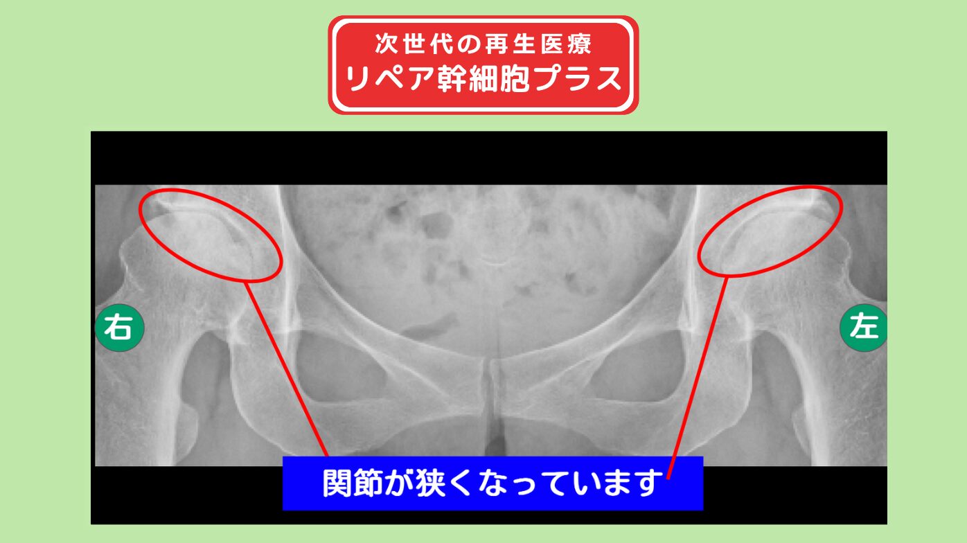 両変形性股関節症