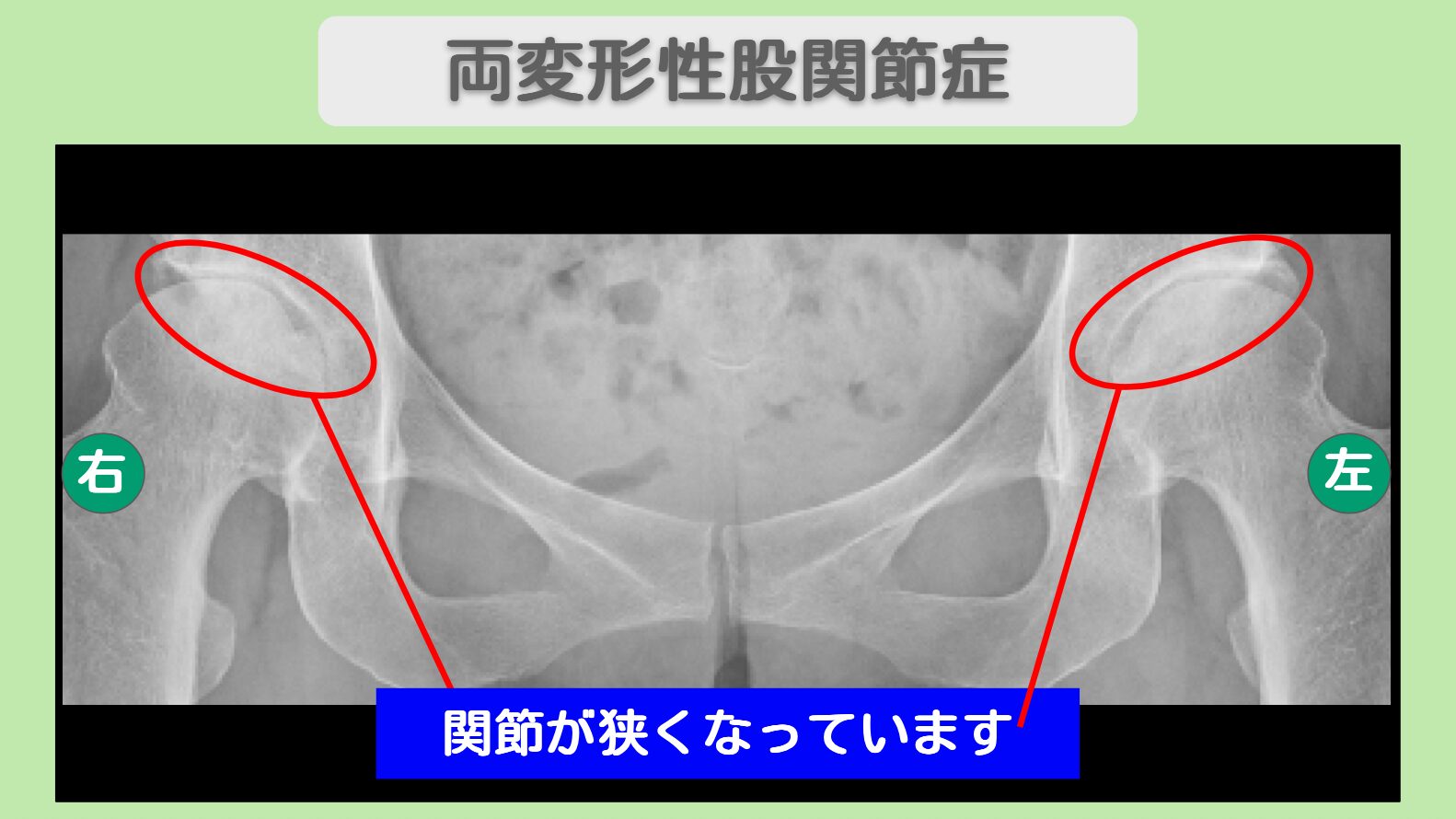 【リペア幹細胞プラス】 両股関節の痛みが完全消失! 両変形性股関節症 50代女性
