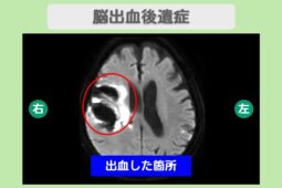 脳出血