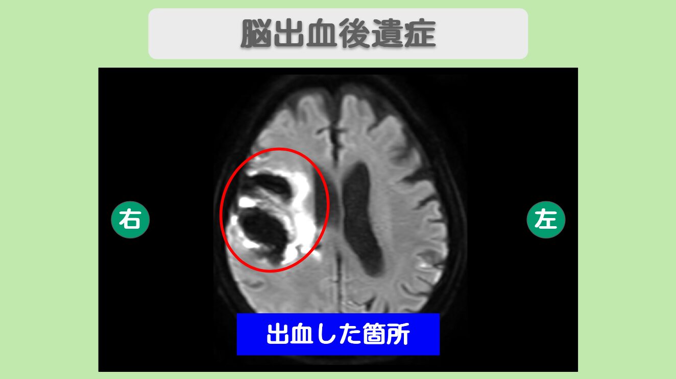 脳出血