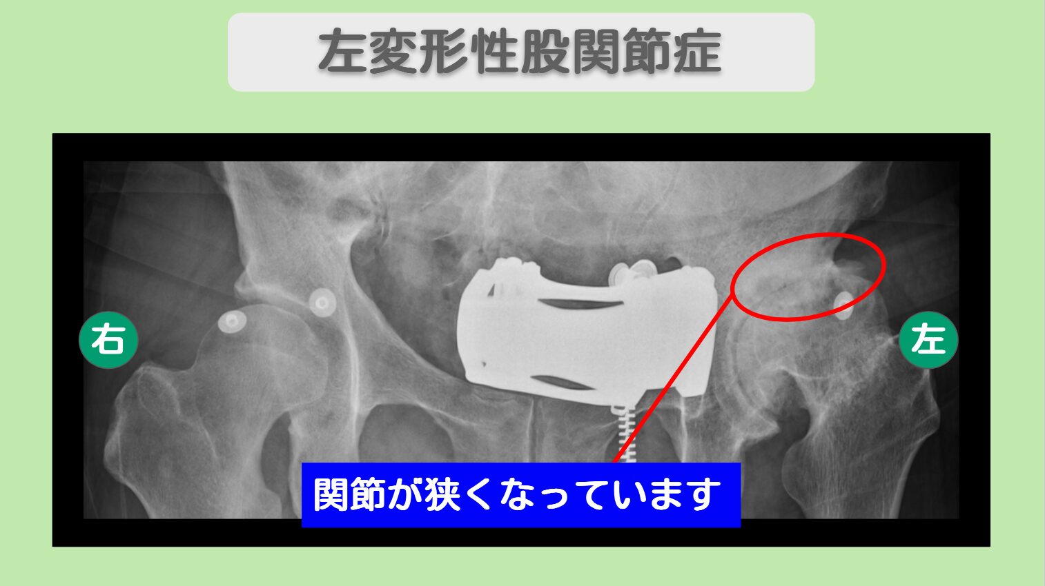 変形性股関節症