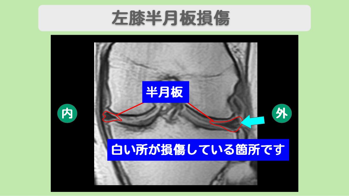 左膝半月板損傷