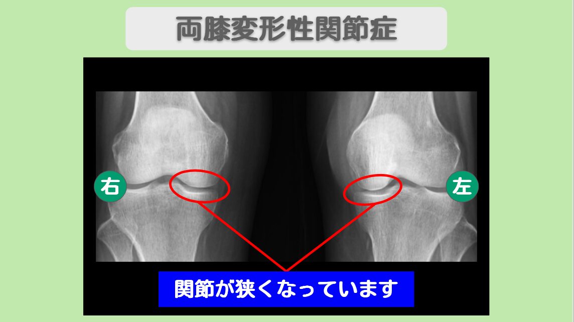 両変形性膝関節症