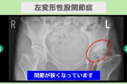 左変形性股関節症