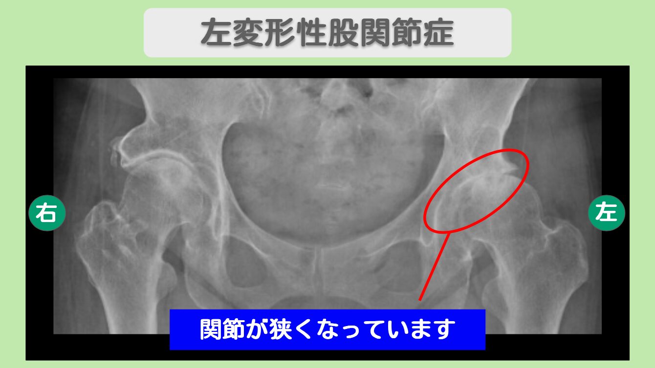 左変形性股関節症