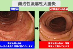 難治性潰瘍性大腸炎