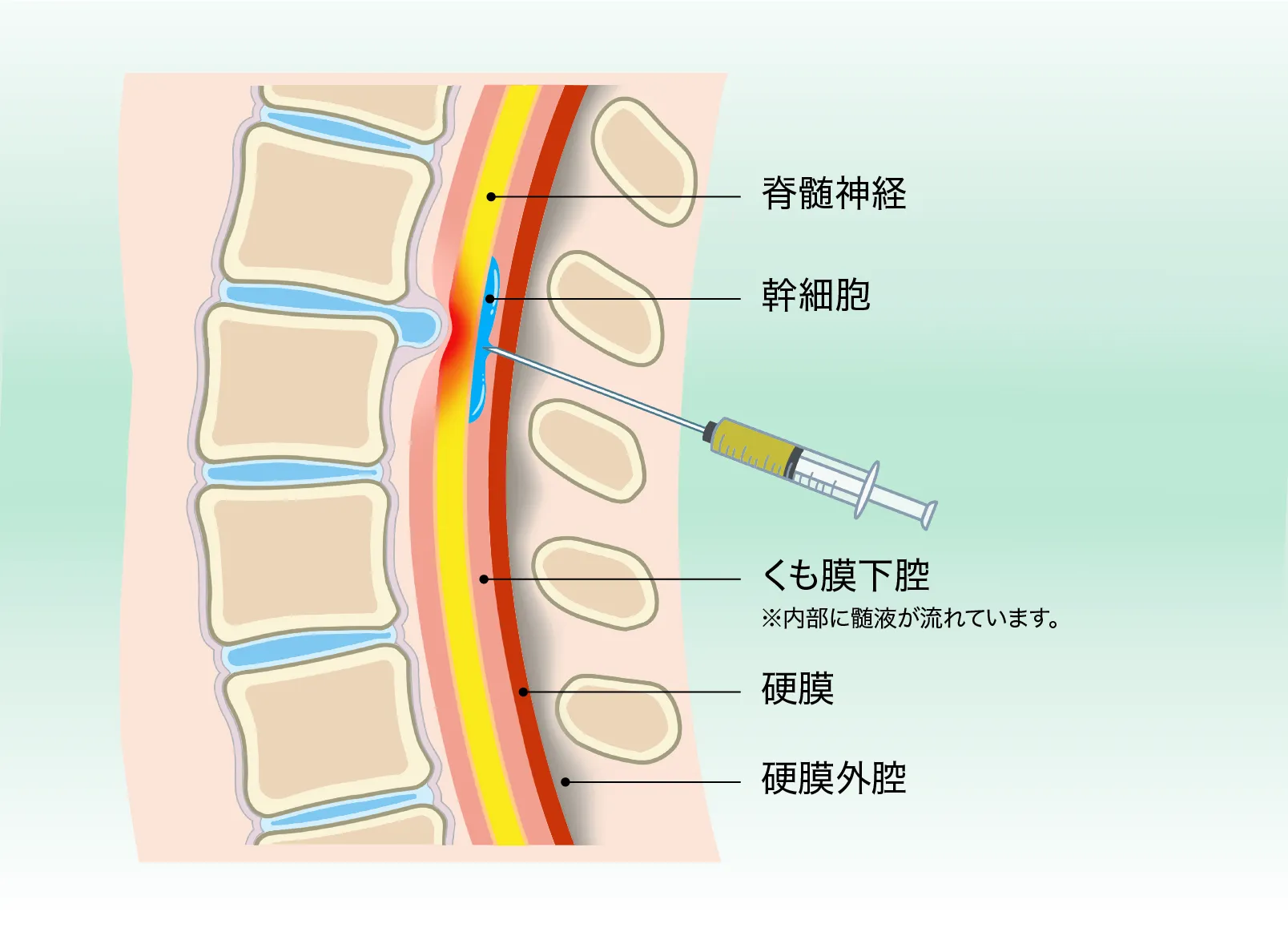 脊髄腔内ダイレクト注射療法