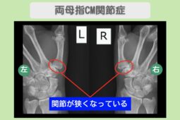 両母指CM関節症