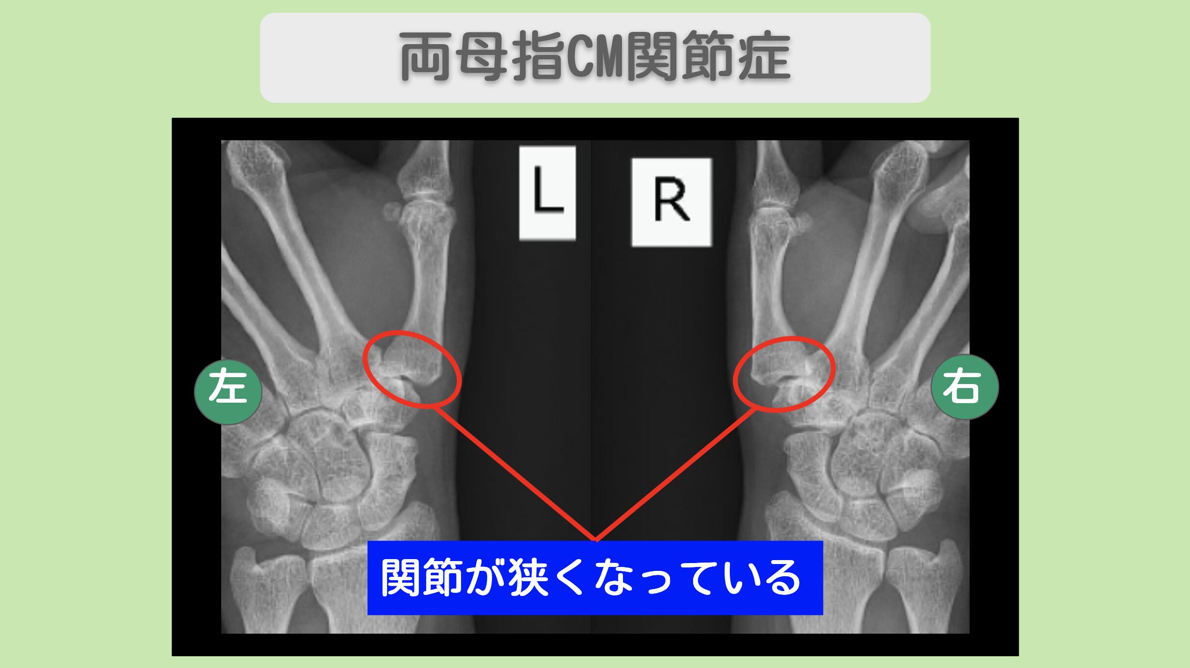 両母指CM関節症