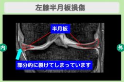 半月板損傷