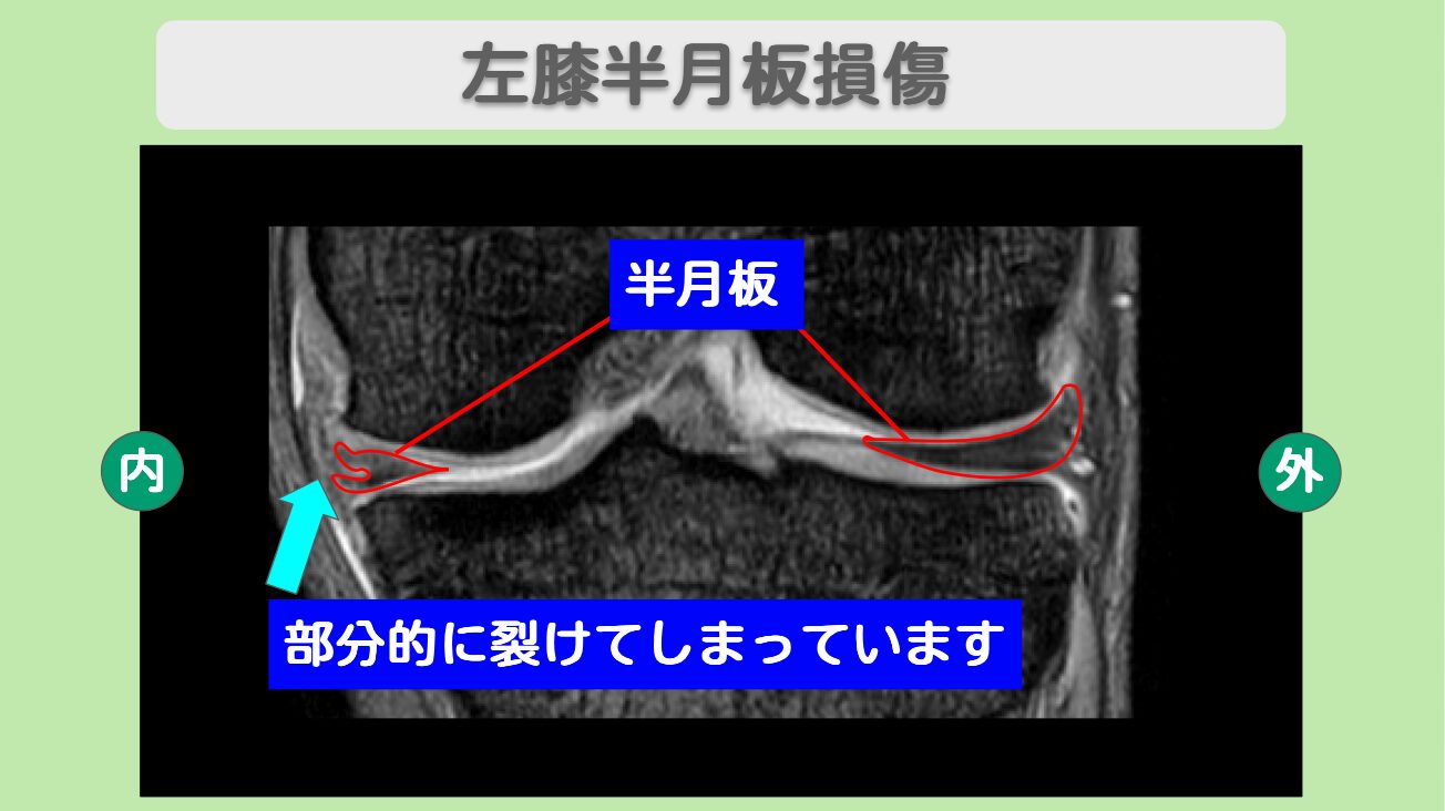 半月板損傷