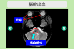 脳幹出血