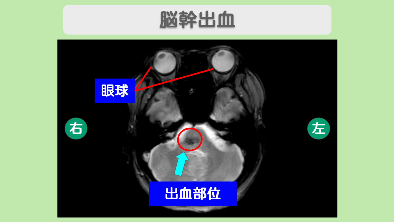 脳幹出血