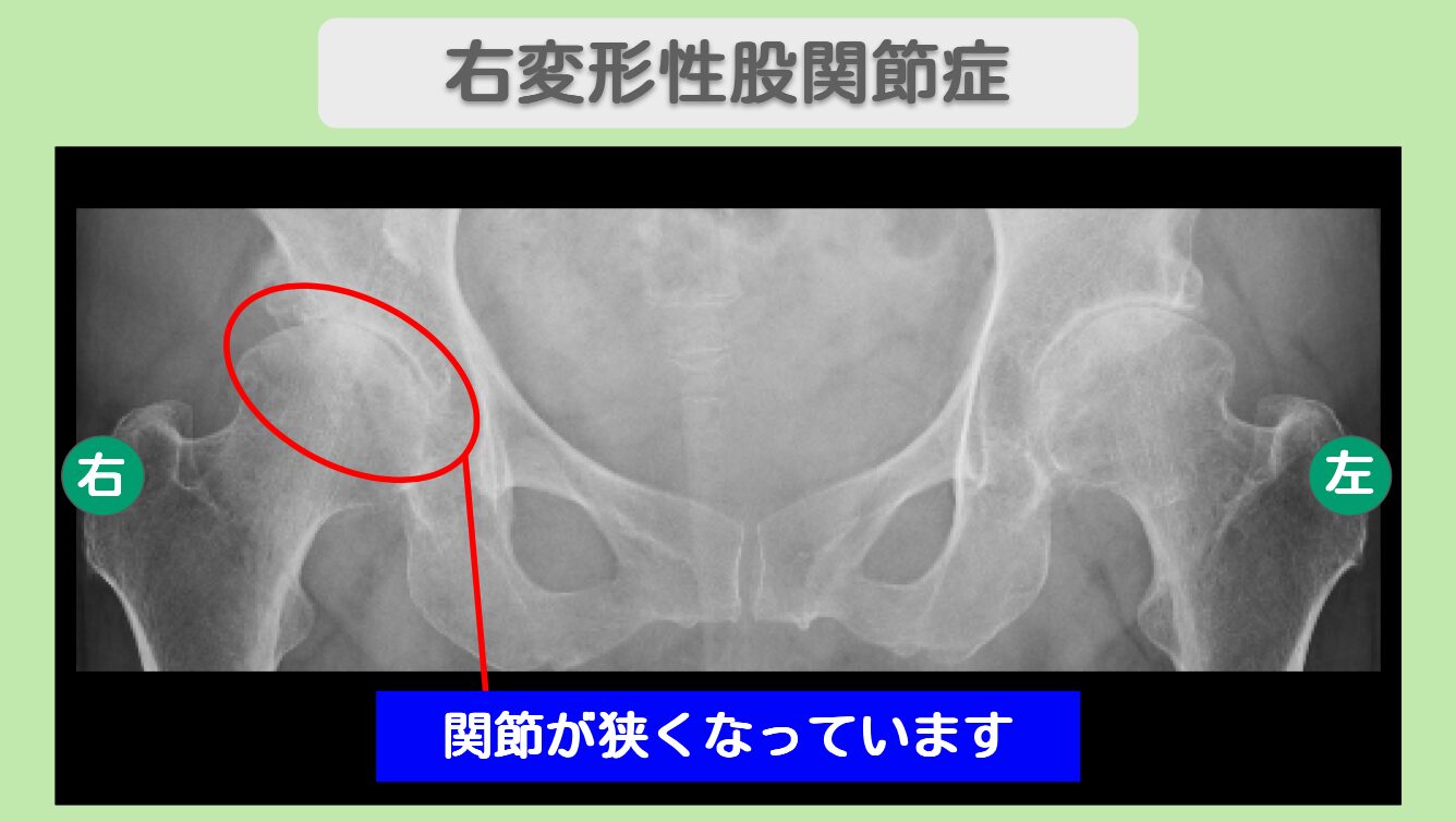 右変形性股関節症