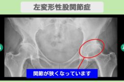 左変形股関節症