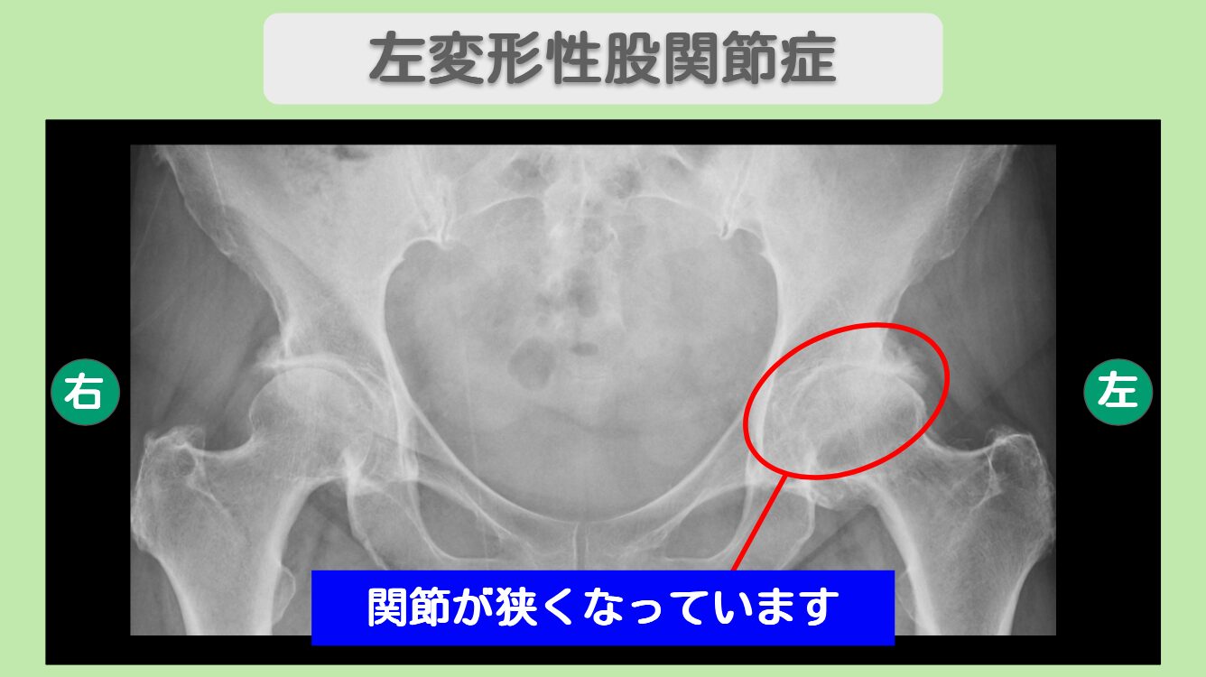 左変形股関節症