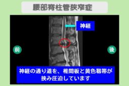 腰部脊柱管狭窄症