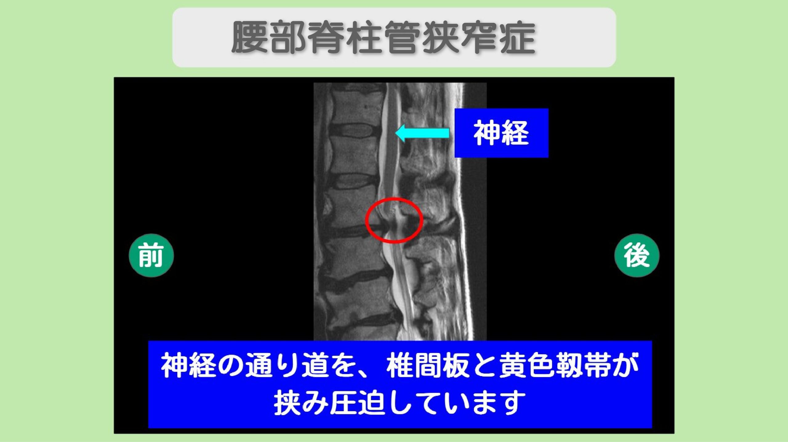 腰部脊柱管狭窄症