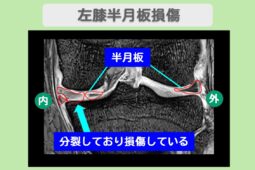 左半月板損傷