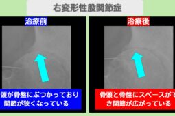 変形性股関節症