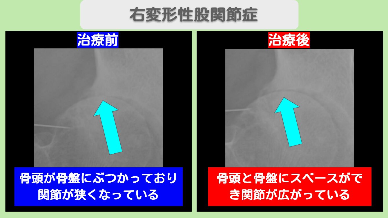 変形性股関節症