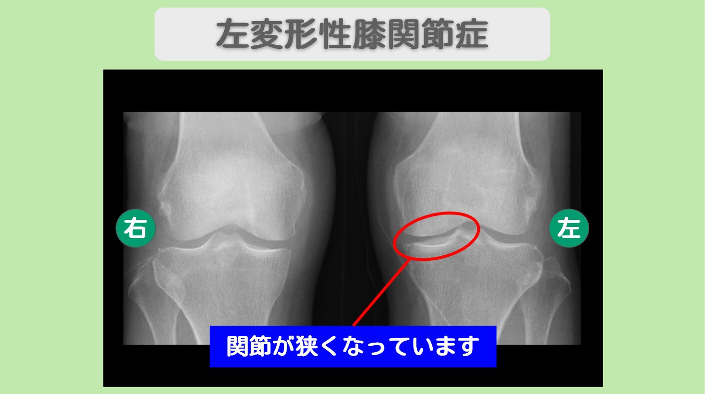 変形性膝関節症
