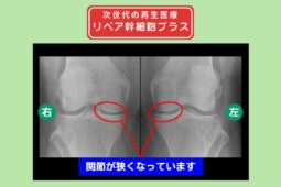 変形性膝関節症