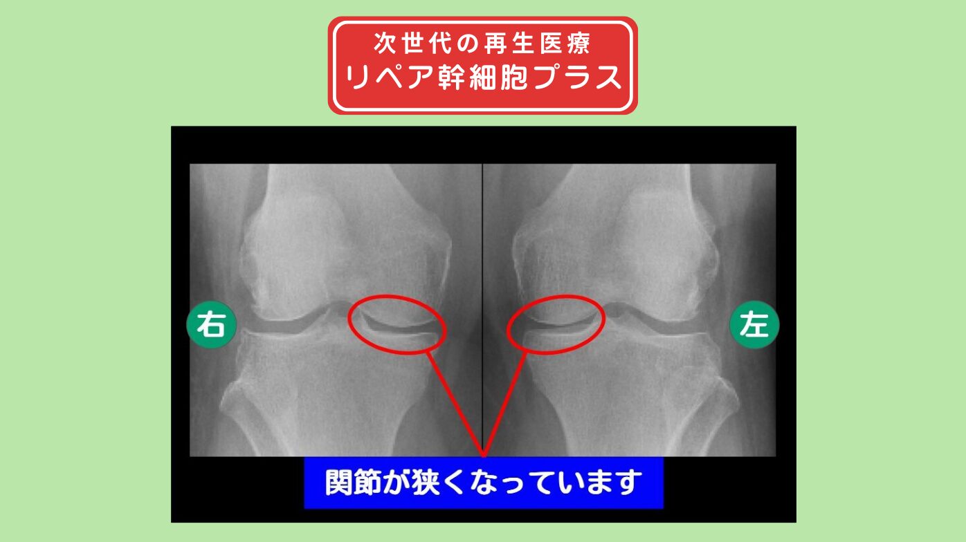 変形性膝関節症