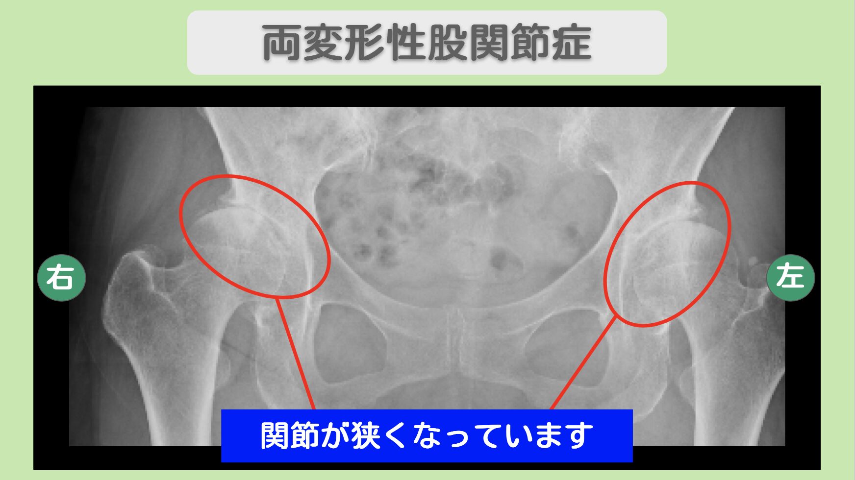 両変形性股関節症