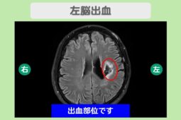 脳卒中幹細胞投与