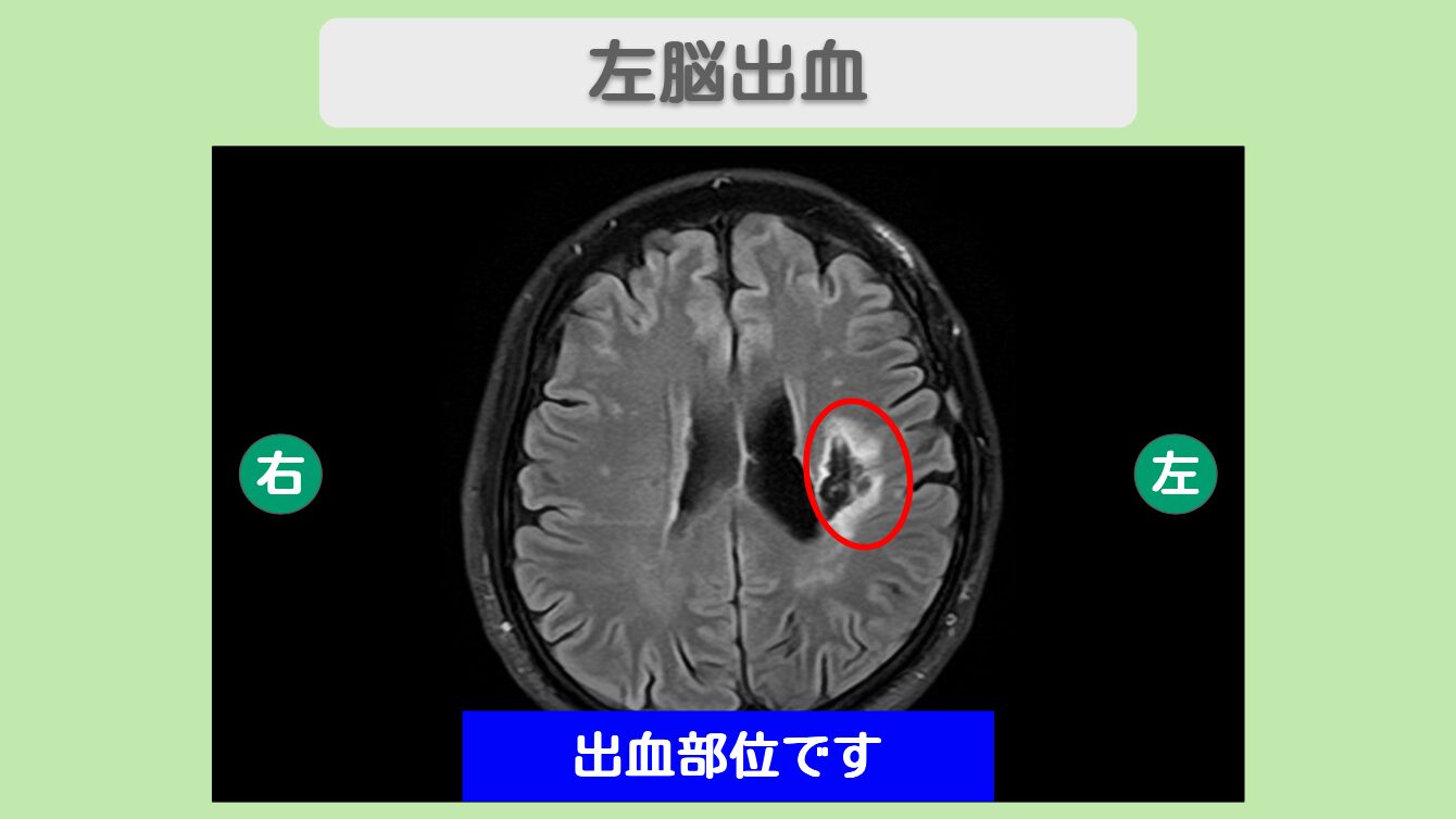 脳卒中幹細胞投与