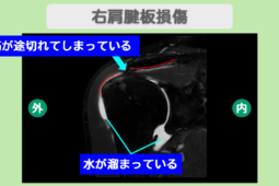 右肩腱板損傷