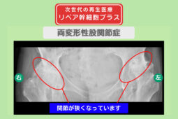 両変形性股関節症
