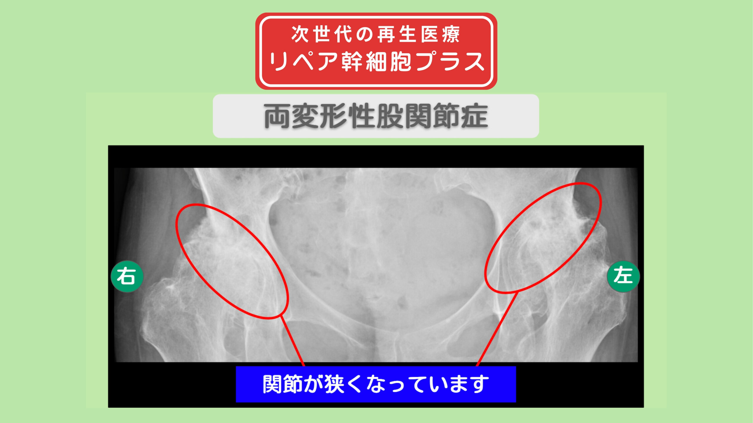 両変形性股関節症