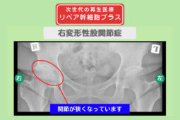 右変形性股関節症