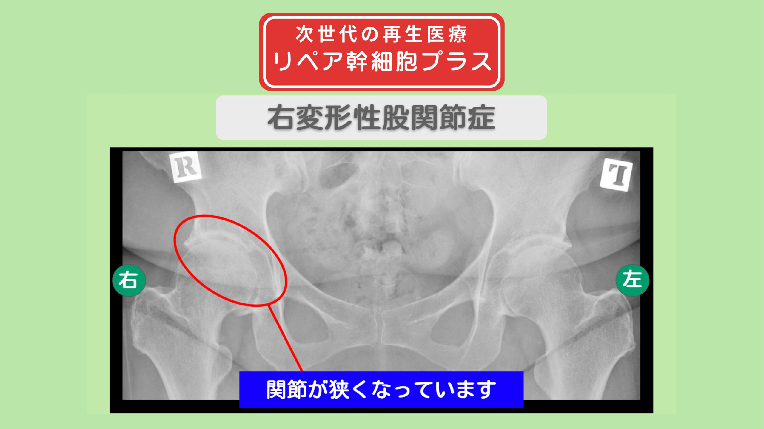 右変形性股関節症
