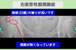 変形性股関節症