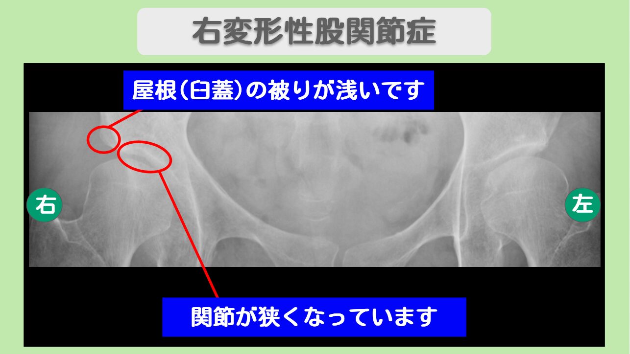 変形性股関節症