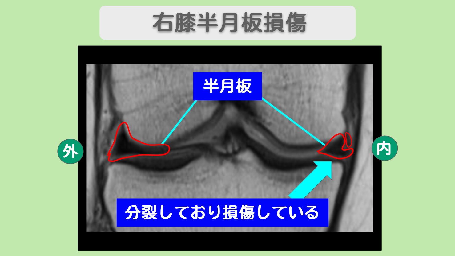 右膝半月板損傷