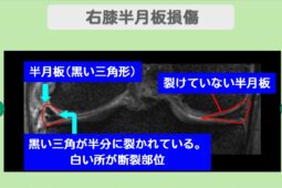右膝半月板損傷