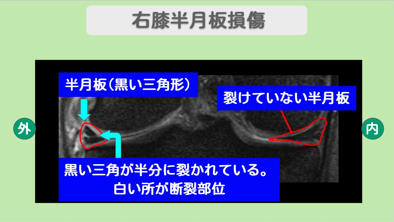右膝半月板損傷