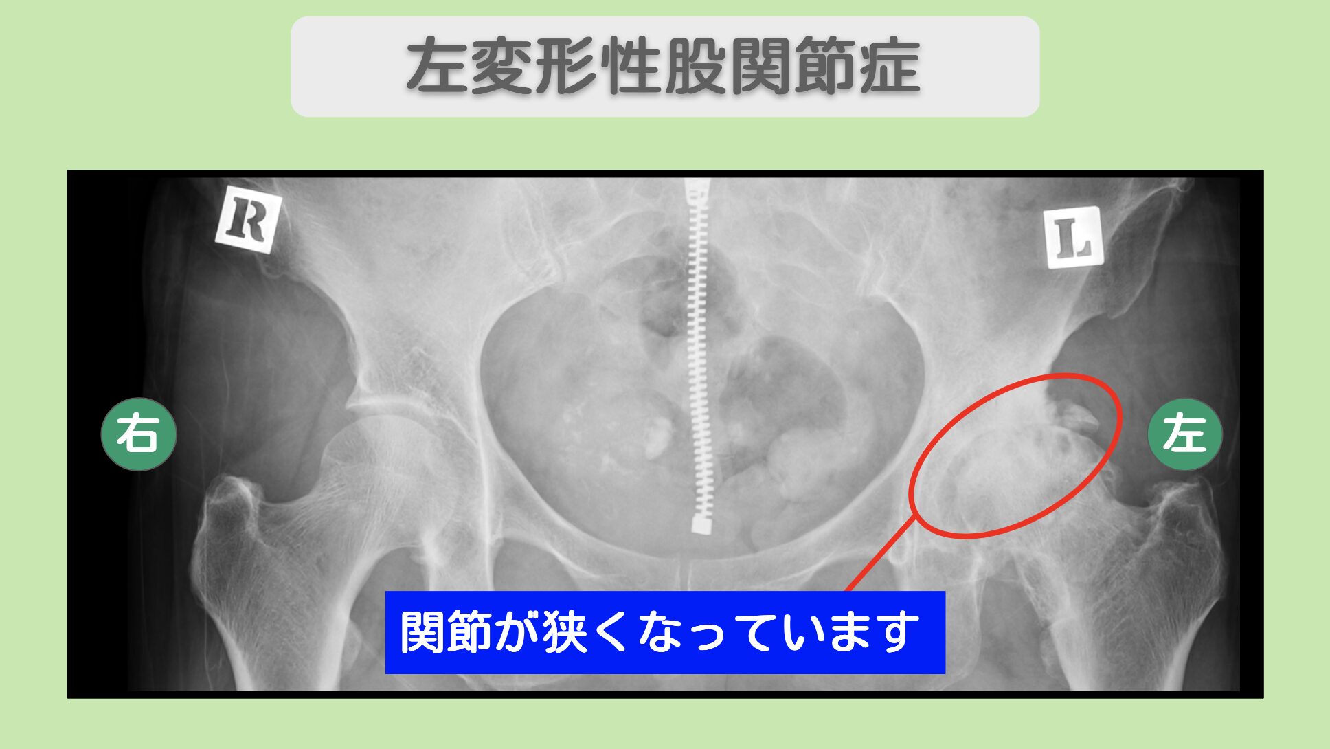 左変形性股関節症