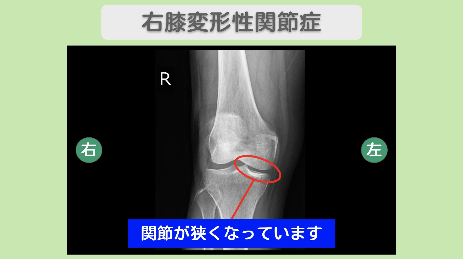右足変形性関節症